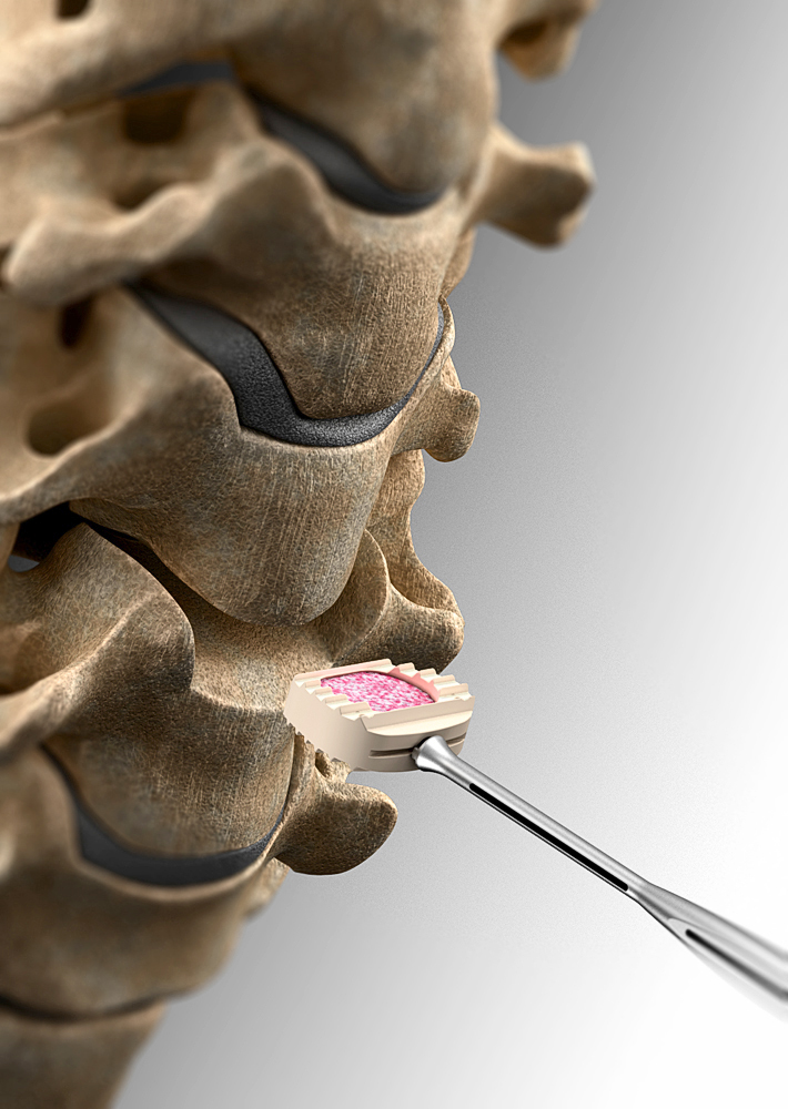 illustration-3D-philippe-raimbault-vertebres-prothese